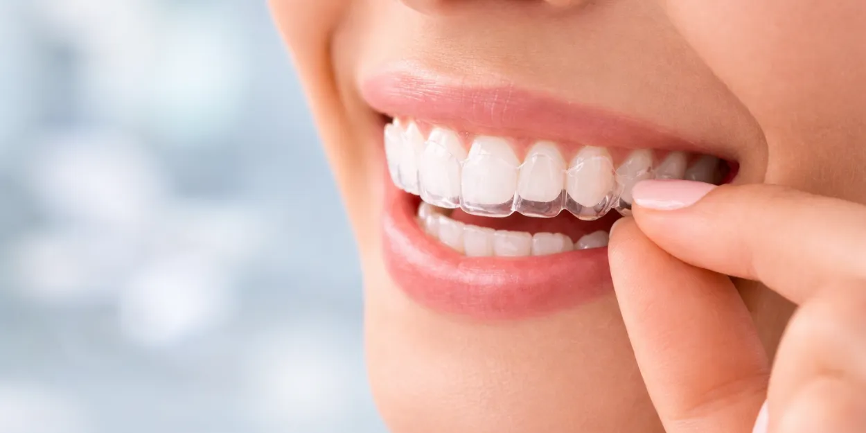 Şeffaf Plak Tedavisi 2.png