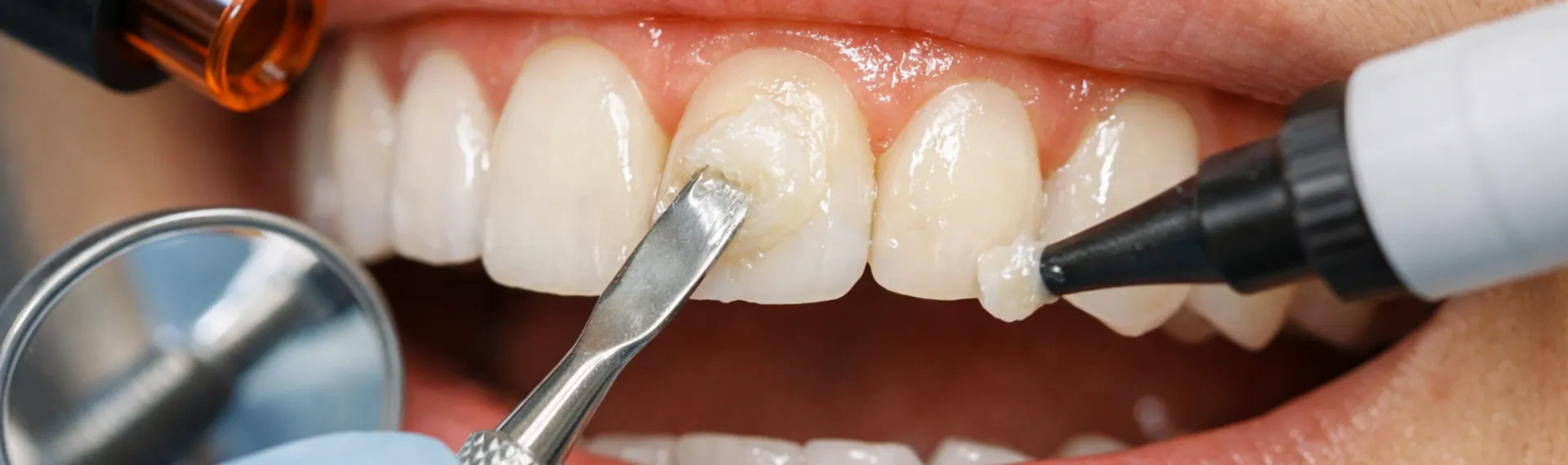 Composite Bonding in Istanbul