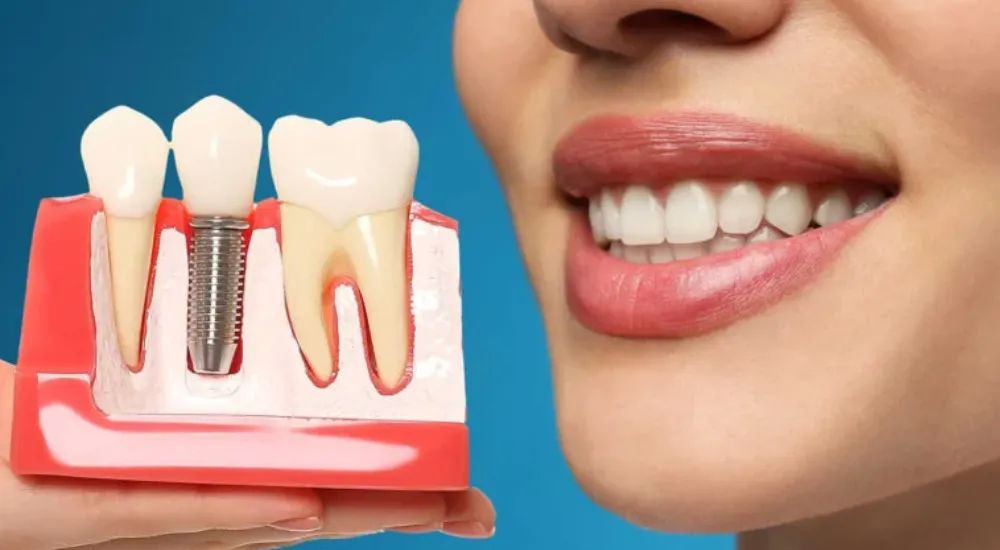 Les implants dentaires causent-ils des caries ou des maladies des gencives?