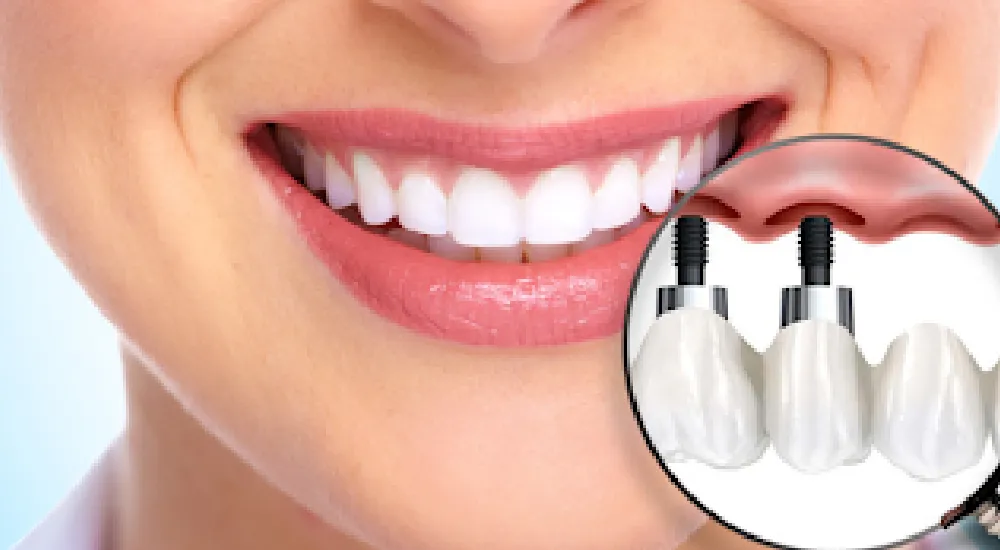 İmplant Protezler Nedir? Çeşitleri Nelerdir? Bakımı Nasıl Olmalıdır?