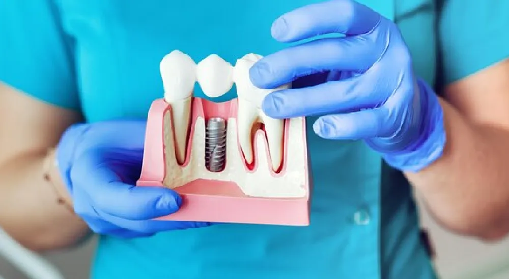 Dental İmplant nedir?