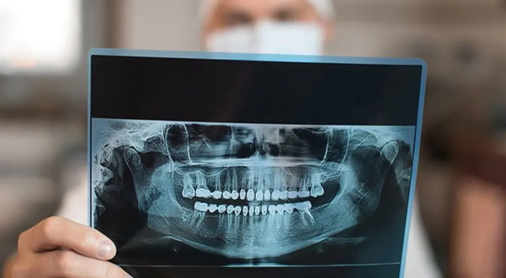 Diş tomografisi hangi durumlarda çekilir ?