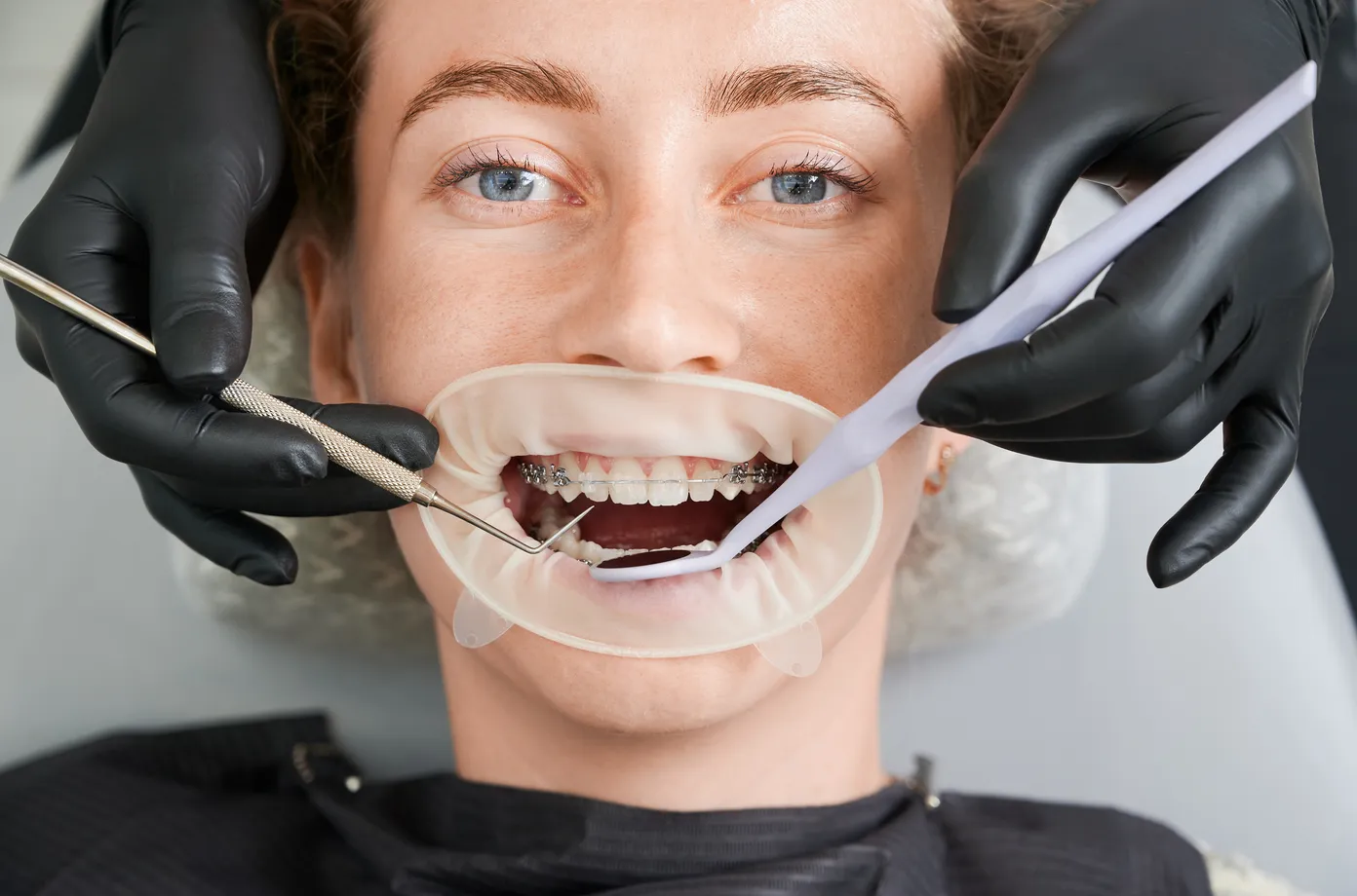 macro-photography-beautiful-girl-with-braces-dental-clinic (1).jpg