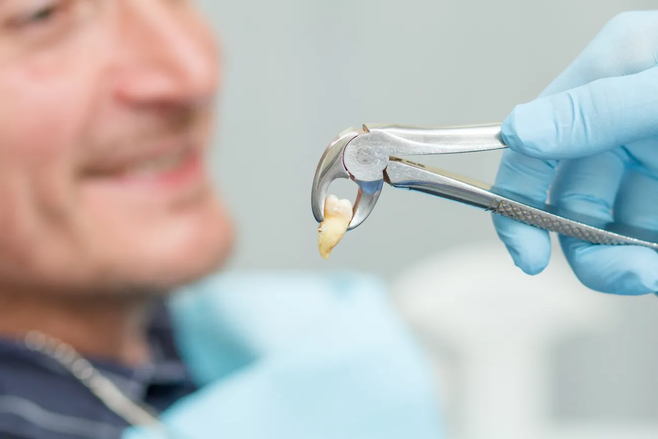 dentist-has-extracted-sick-tooth-from-patient-dental-office-focus-stainless-steel-dental-tongs-pliers-extracted-lower-tooth-it-dentistry (1).jpg