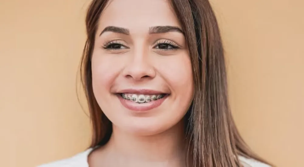 Diş Teli Takanlar Ne Yiyemez?