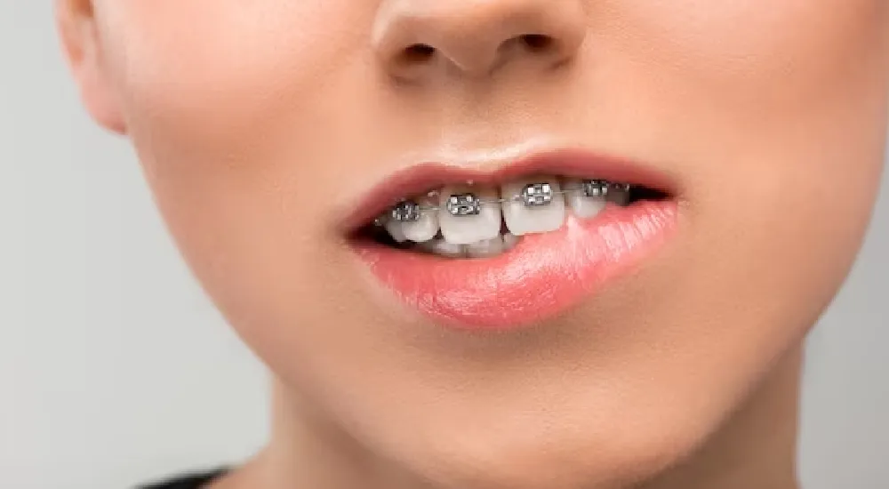 Diş Teli Kaç Yaşına Kadar Takılabilir?