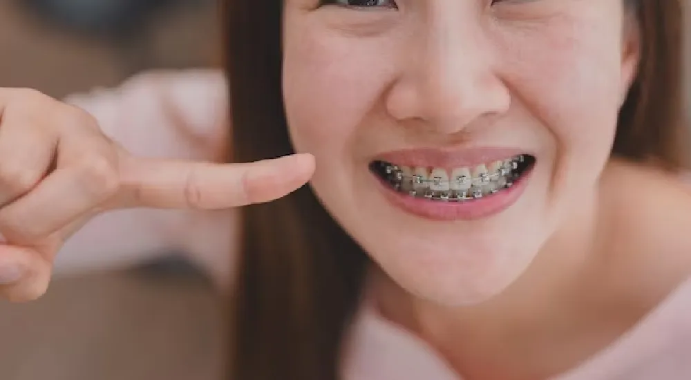 Diş Teli Kimlere Takılmaz?