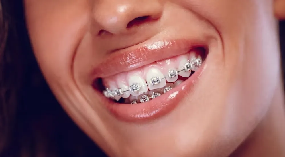 Diş Teli Hangi Durumlarda Takılır?