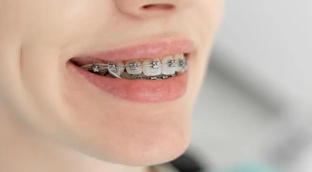 Diş Teli Varken Dondurma Yenir mi?