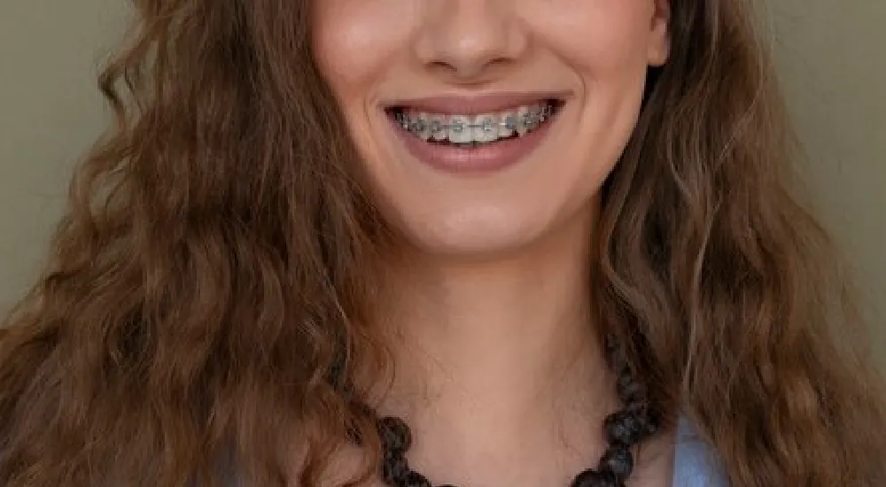 Diş Teli Takıldıktan Sonra Ne Yenmez?