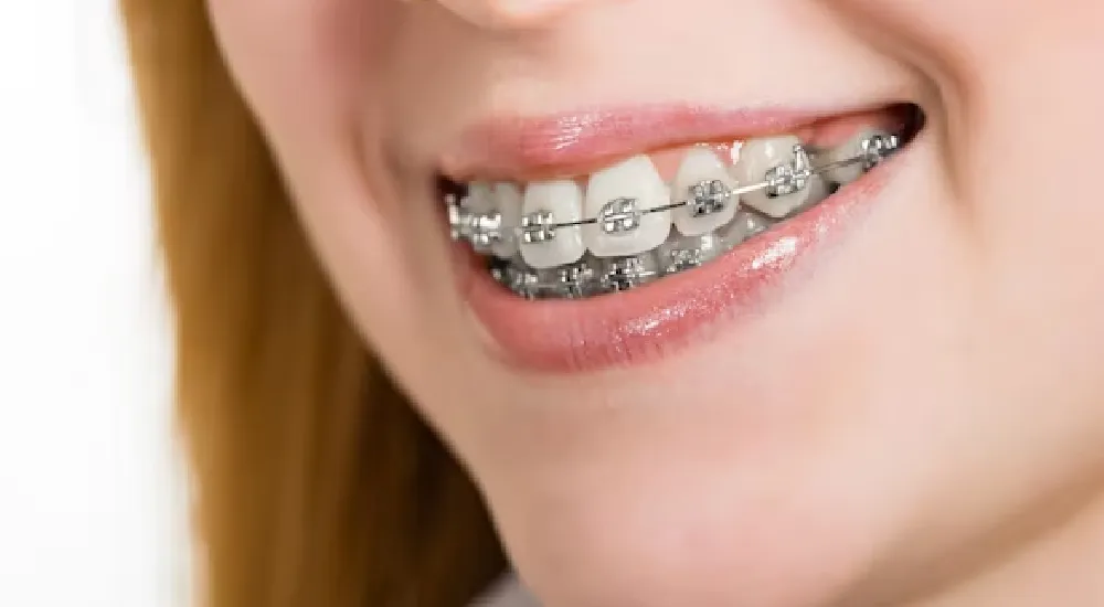 Diş Teli Acıtır mı?