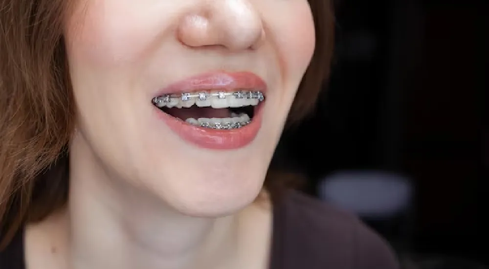 Porselen Diş Teli Nedir ve Hangi Tedavilerde Kullanılır?