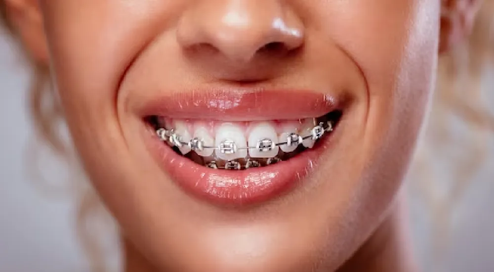 Diş Teli Çıktıktan Sonra Dişlerim Bozulur mu?