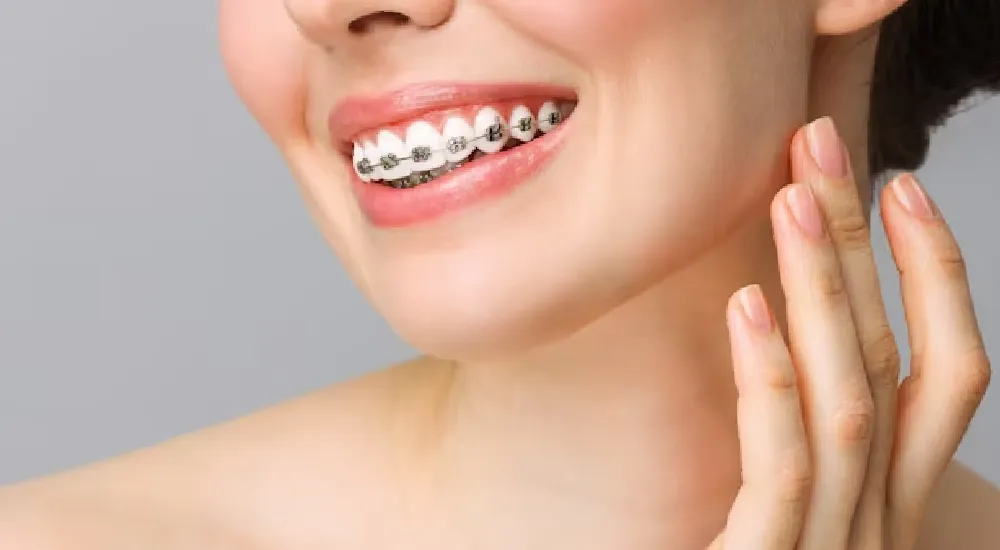 Diş Teli Ne Kadar Süre Kalır?