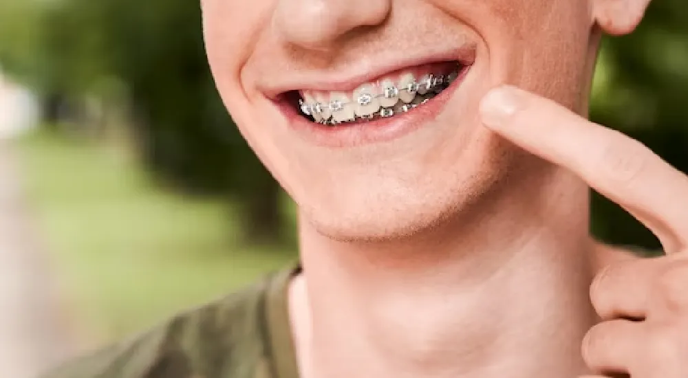 Diş Teli Takıldıktan Sonra Dişler Ne Zaman Düzelmeye Başlar