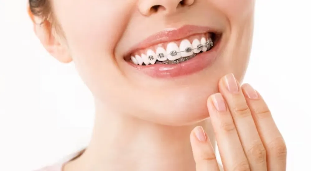 Diş Teli Yüzü Değiştirir Mi?