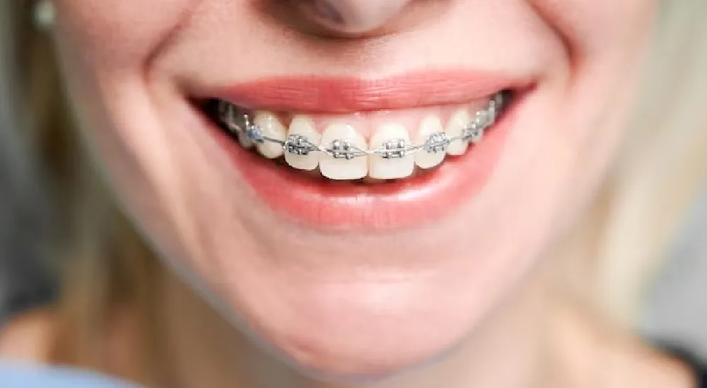 Diş Teli Tedavisi: İlk Gün Ne Yenmeli?